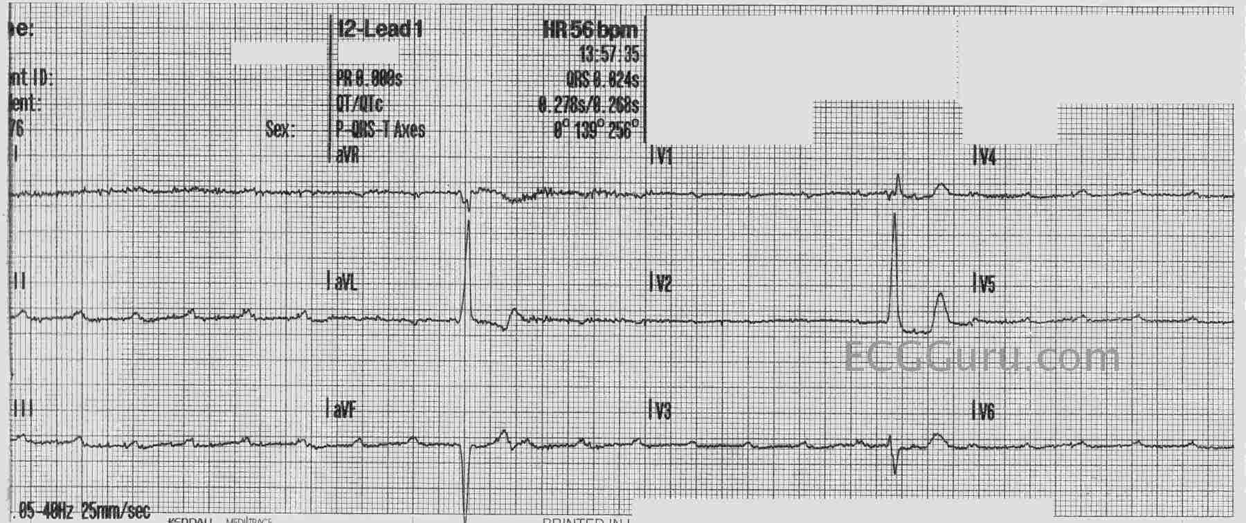 Complete Heart Block ECG Guru Instructor Resources
